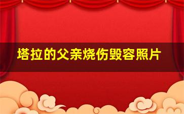 塔拉的父亲烧伤毁容照片