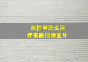 灰指甲怎么治疗彻底根除图片