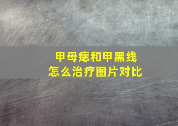 甲母痣和甲黑线怎么治疗图片对比